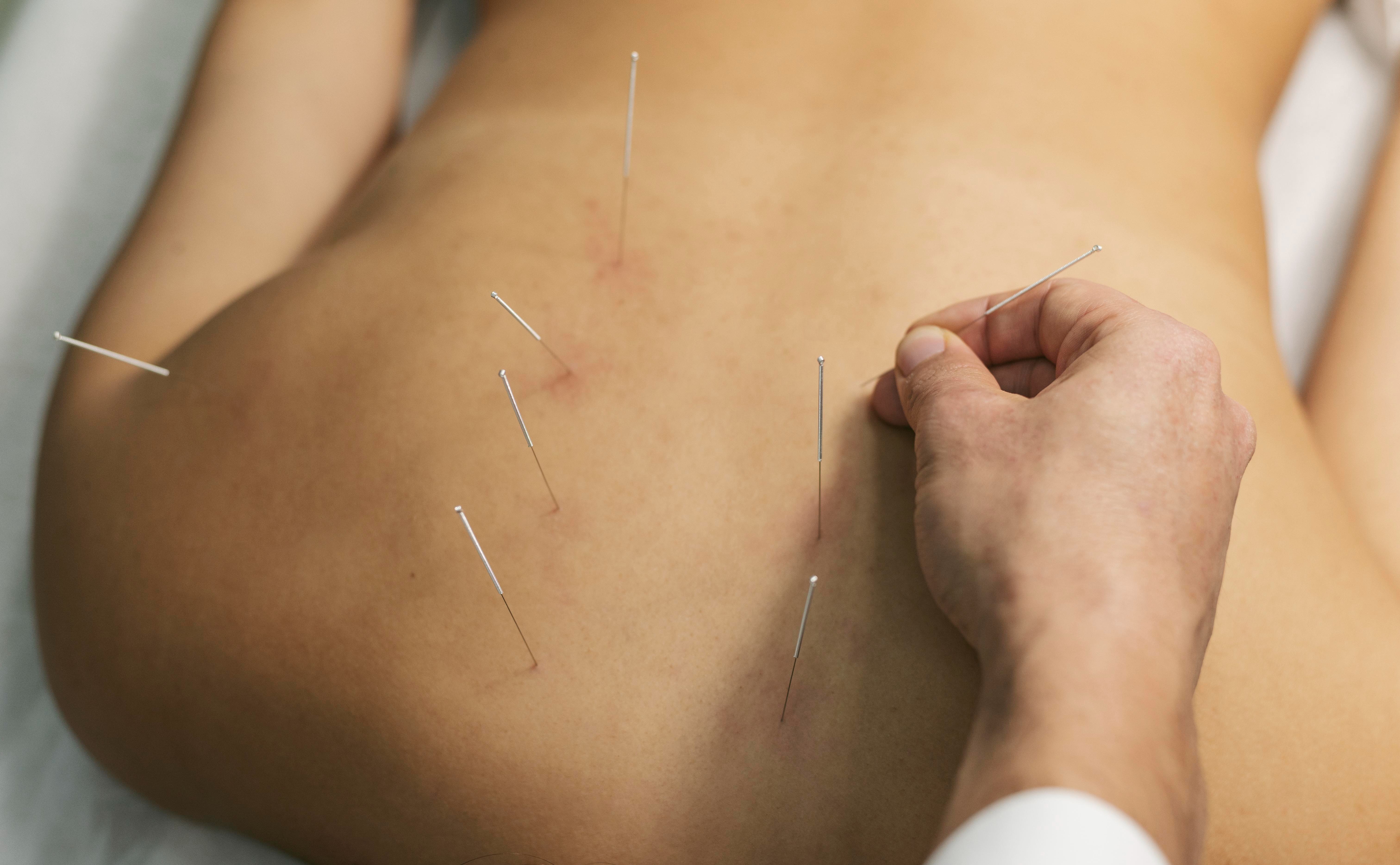 Acupunturist